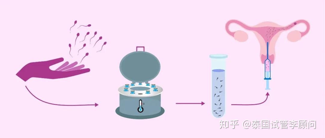 供卵做试管婴儿一代、二代和三代的区别是什么二代和三代的区别是什么