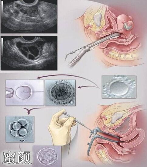 如何治疗巧囊,需要切除卵巢吗+